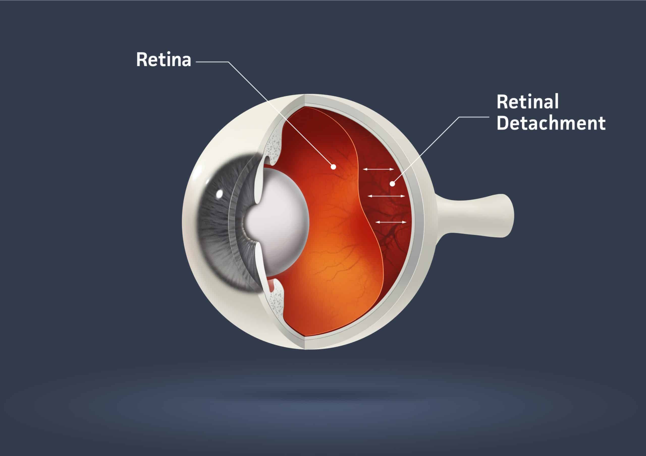 Advancing Clarity: Exploring the Latest in Retinal Treatments