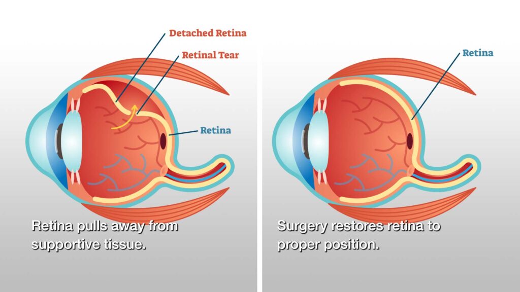 Retinal Treatments